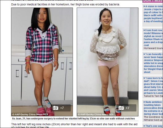 中国人女性、1年で脚を23cm伸ばすことに成功！　1日1mmまで!? 仰天治療!!の画像1