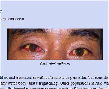 leptospirosis_2.jpg