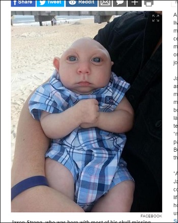 microhydranencephaly_3.jpg