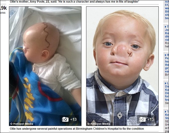 本物のピノキオと呼ばれた赤ん坊 ― 脳が鼻から飛び出る「脳ヘルニア」とは？の画像2