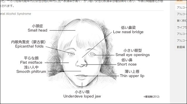 【ガチ】妊娠中の少量飲酒で新生児の顔が激変することが判明、こんな顔になる! 鼻が低く、小頭で小さい目に…の画像2