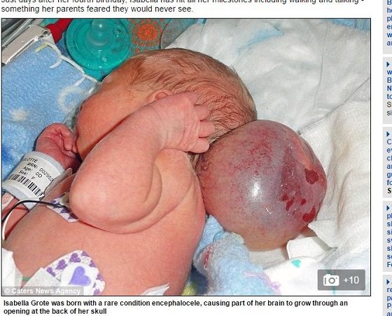 【脳奇形】後頭部から巨大な透明ボールが飛び出た赤ん坊　奇跡の成長＝米ミネソタ州の画像1