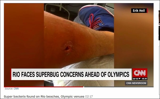 【リオ五輪】会場の海に日々浮かぶ死体がヤバすぎる!致死率50%の「スーパーバクテリア」もの画像5