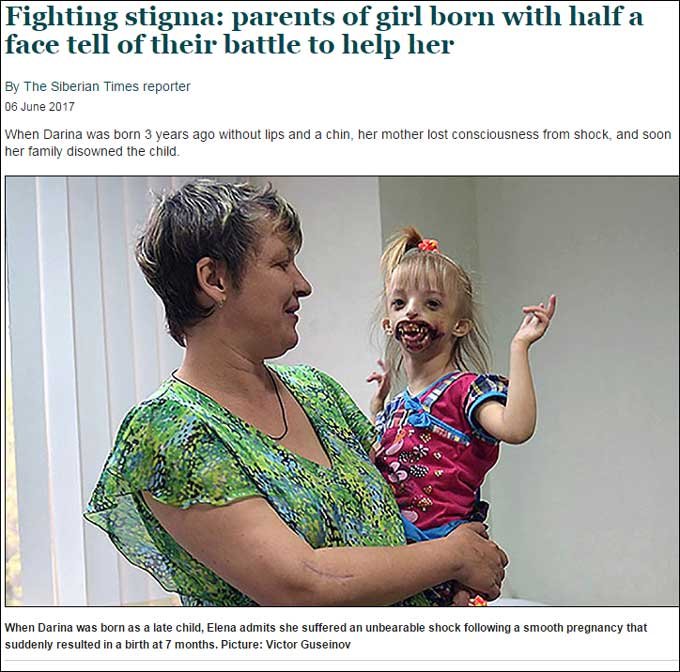 【閲覧注意・奇形】唇がくり抜かれた少女ダリア ー 口の中が剥き出しで生まれて =ロシアの画像1