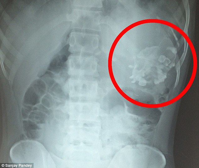 【閲覧注意】男の腹の中から毛むくじゃらの人間が出現=インドの画像2