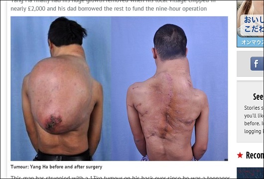 13kgの巨大腫瘍を背負っていた男! 大人4人分の輸血を伴う手術の末に……の画像2
