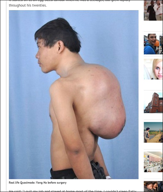 13kgの巨大腫瘍を背負っていた男！　大人4人分の輸血を伴う手術の末に……の画像1