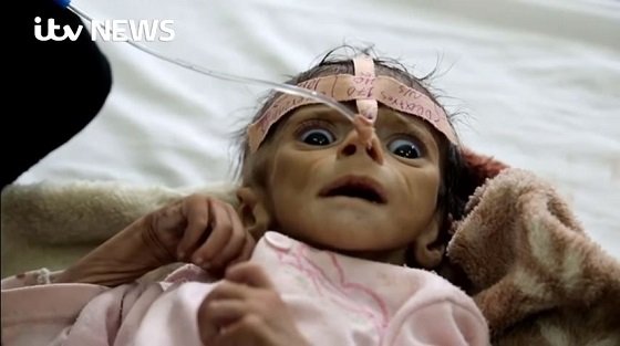 餓死する2日前の子どもの瞳が訴えかけるものとは？ 骨と皮になった生後5カ月の赤ん坊は絶望を見て死んだ＝イエメンの画像1