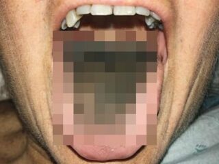 【閲覧注意】舌から“真っ黒な毛”が生えた女性― 細菌が引き起こす「黒毛舌」の獣的異形＝米