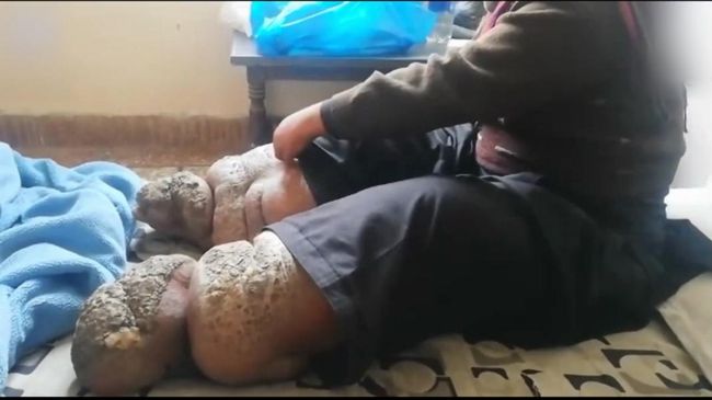【閲覧注意】足がどんどん巨大化&石化中の男、苦しみの悲鳴! 蚊に刺されただけで… 奇病以上の苦悩も=パキスタンの画像4