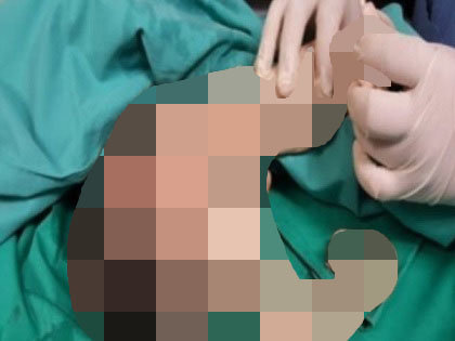【閲覧注意】少年の胃の中で密かに成長していた兄弟 ― ふさふさ髪からペニスまで形成された「成熟奇形腫」の恐ろしい姿=マレーシアの画像2