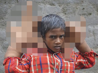 「育ちすぎる巨大な手」を持つ8歳の少年 ― 膨張が止まらぬ謎の症状に医師も困惑＝インド