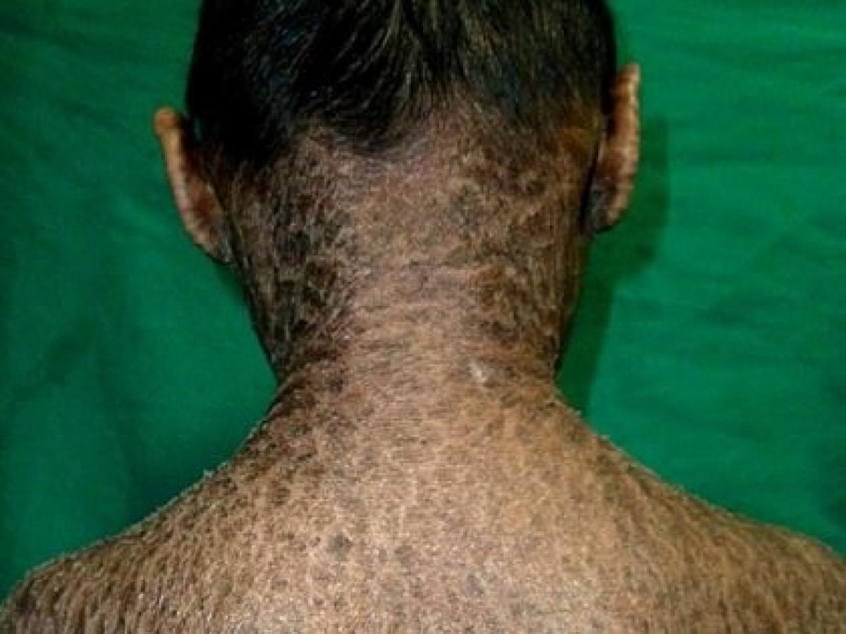 ウロコで全身を覆われた姉弟 皮膚がひび割れ 剥がれ落ちる難病と徹底的差別の実態 インド