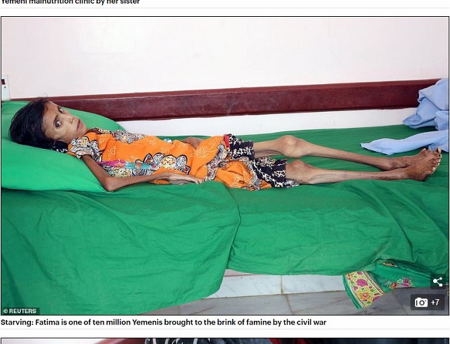 イエメン内戦で 体重10kg まで痩せた少女の姿に全世界衝撃 完全に 骨と皮 で医者も治療拒否 飢餓千万人の絶望的状況