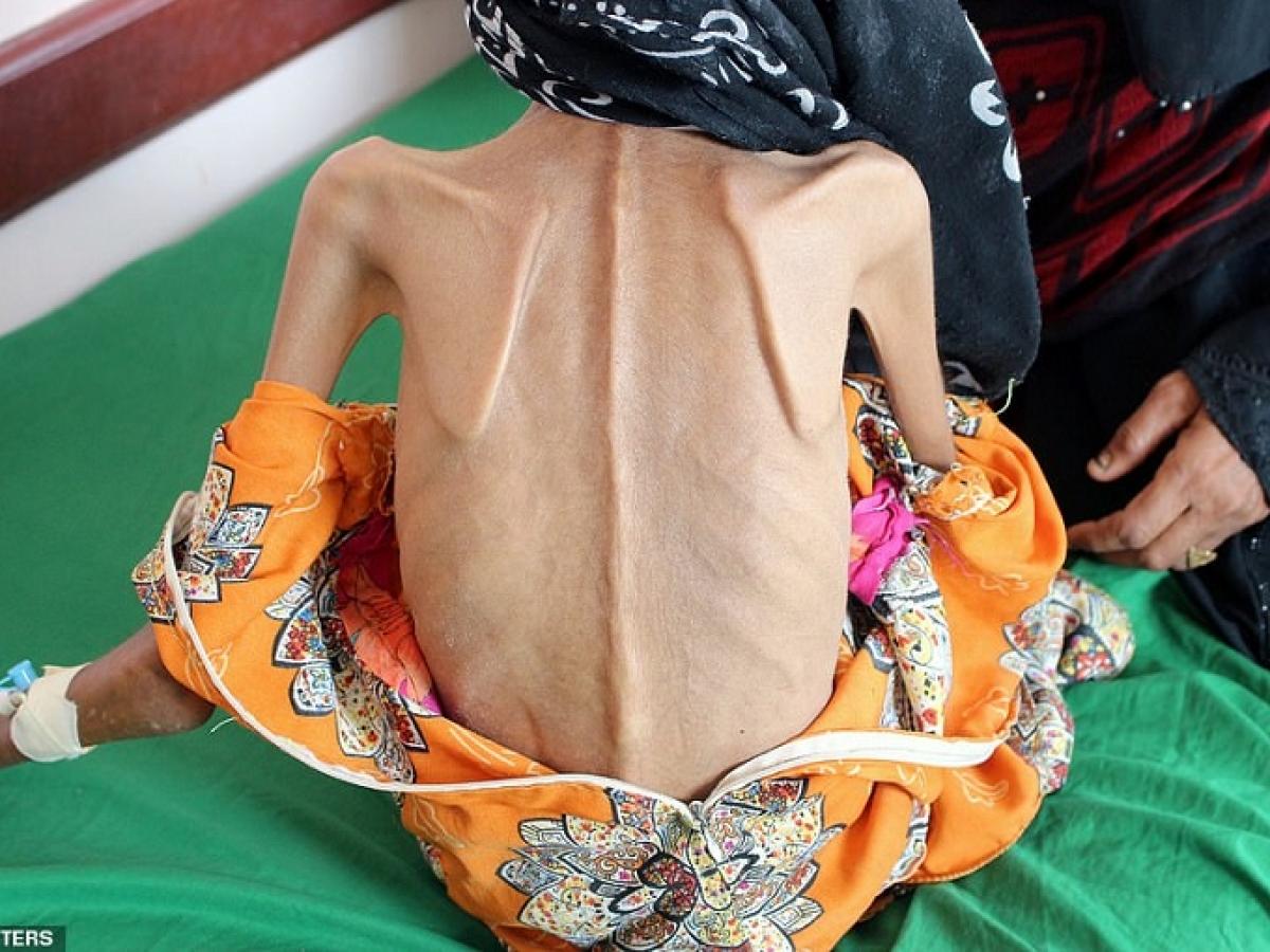 イエメン内戦で 体重10kg まで痩せた少女の姿に全世界衝撃 完全に 骨と皮 で医者も治療拒否 飢餓千万人の絶望的状況
