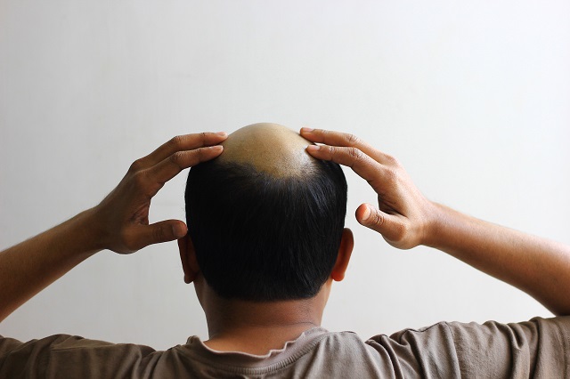 禿げた時のための「ヘアバンク」1年以内に開始！ 頭皮細胞を保存&培養… 格安特価でハゲ絶滅へ「人生の保険だ」の画像1