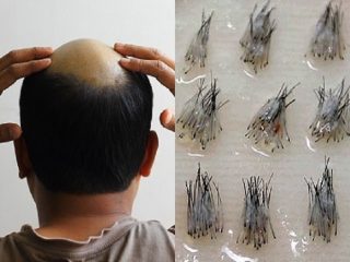 禿げた時のための「ヘアバンク」1年以内に開始！ 頭皮細胞を保存&培養… 格安特価でハゲ絶滅へ「人生の保険だ」
