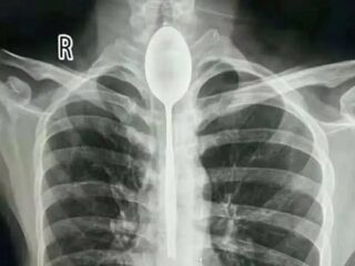 金属スプーン20cmを喉に引っかけたまま1年暮らしていた男！ 医者に行ったら想像以上にヤバい症状が…！