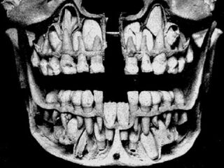 【頭蓋骨は語る】乳歯が抜ける前の子どもの口の中が衝撃的にヤバすぎる！