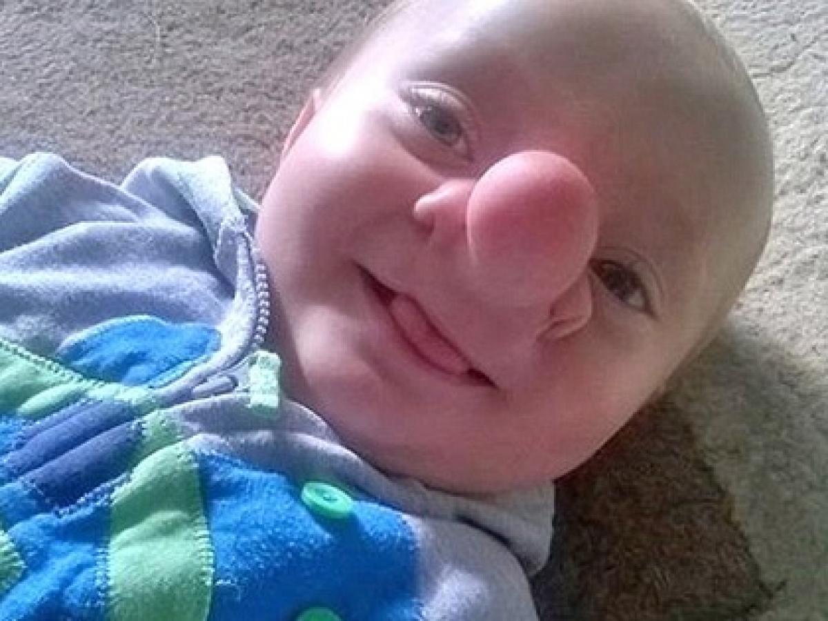 本物のピノキオu201dと呼ばれた赤ん坊 u2015 脳が鼻から飛び出る「脳ヘルニア 