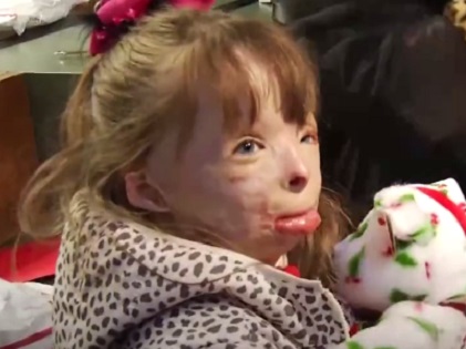 放火で家族を失い重度の火傷を負った少女が 世界中からのクリスマスカード を希望 放火で家族を失い重度の火傷を負った少女が 世界中からのクリスマスカード を希望