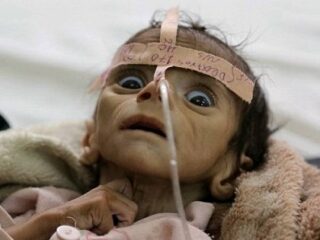 餓死する2日前の子どもの瞳が訴えかけるものとは？ 骨と皮になった生後5カ月の赤ん坊は絶望を見て死んだ＝イエメン