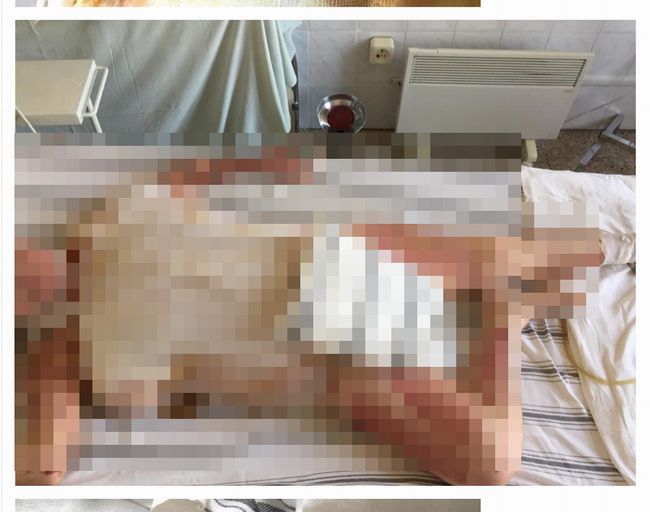 【閲覧注意】硫酸をかけられた女性活動家が死ぬまでの96日間が公開される! 皮膚溶け、視力喪失… 「犯人に見せつけたい」=ウクライナの画像1