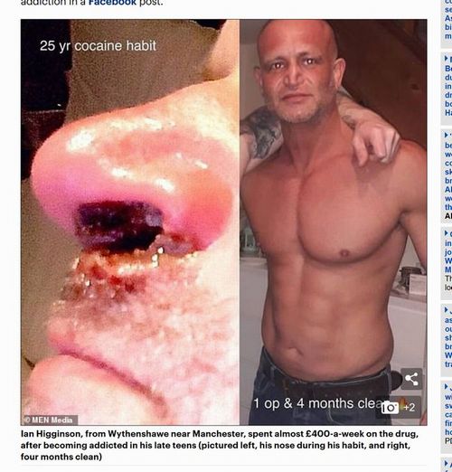 【閲覧注意】ピエール瀧にも見せたい「コカインを25年間やり続けた男の鼻」! 肉が腐れ落ち、穴がつながり… 悲惨すぎる代償=英の画像2