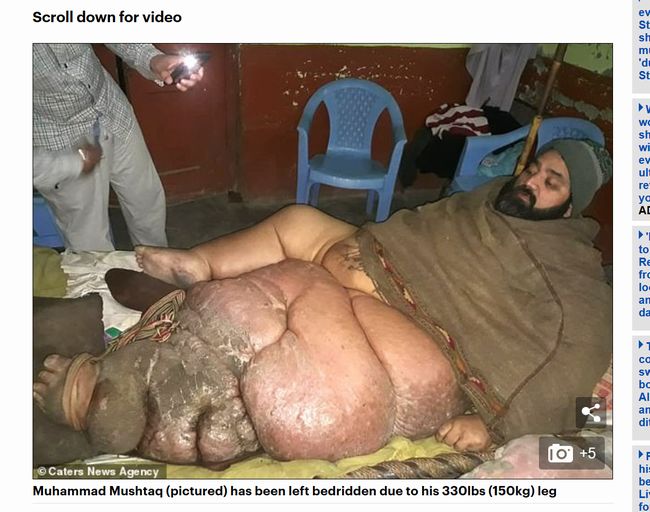【閲覧注意】左足が150kgに肥大して体重300kgの寝たきりになった巨漢肉屋の苦悩！ 「象皮病」患部を切断したいが…＝パキスタンの画像2