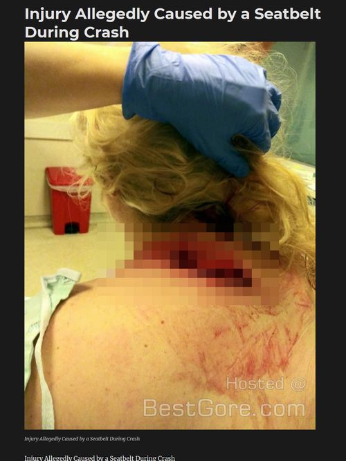 【閲覧注意】シートベルトで逆に怪我した女がヤバすぎる! 肩が刀で切られたようにぱっくり… 命綱が凶器に!の画像1