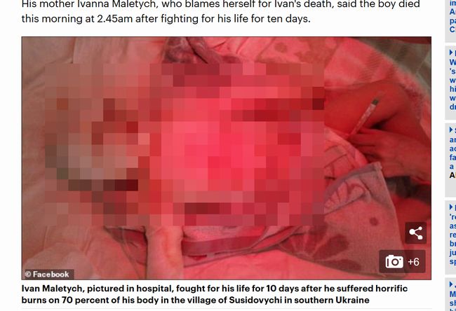 【閲覧注意】熱湯鍋に落下して死んだ2歳男児がヤバすぎる! 母が目を離した隙に… 全身火傷、包帯血まみれ、悔やみきれない両親の悲痛の画像1