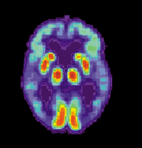 アルツハイマー病とは異なる認知症「LATE」が発見される！ 25％以上が発症する可能性！の画像3