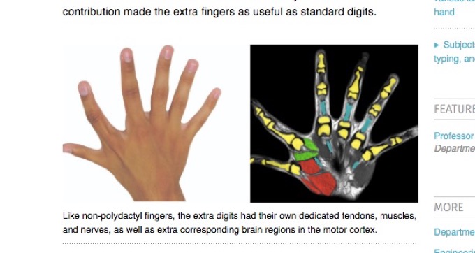 多指症は5本指より器用＆便利だったことが判明！ タイピング、ゲームも断然有利の画像2