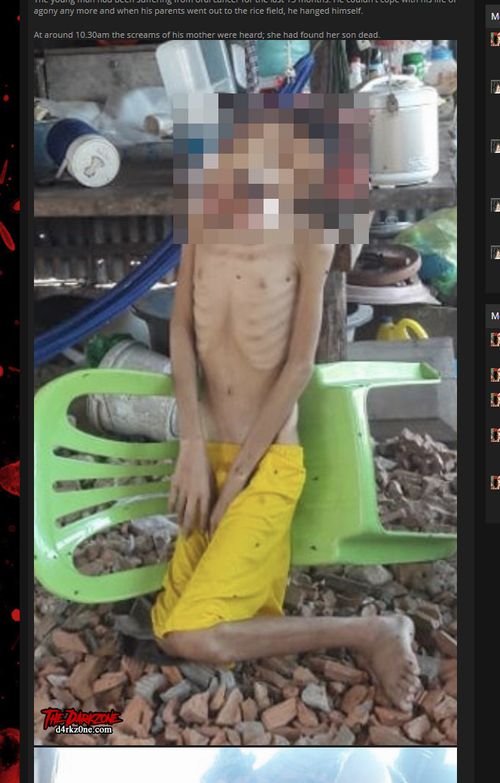 【閲覧注意】史上最も痛ましい首吊り自殺画像! 口腔がんでクチが完全崩壊した18歳男性… 満足な治療を受けられず=カンボジアの画像2