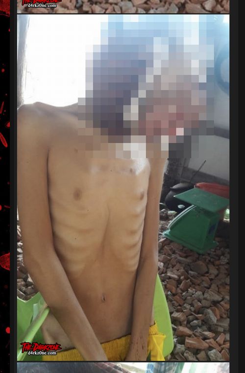 【閲覧注意】史上最も痛ましい首吊り自殺画像! 口腔がんでクチが完全崩壊した18歳男性… 満足な治療を受けられず=カンボジアの画像3