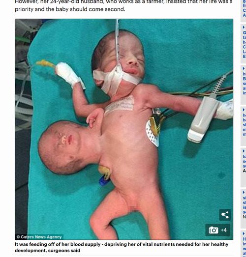 【閲覧注意】胸から余分な頭と手が生えた奇形性双生児、分離手術に成功! 無償で行われた手術の過程がスゴい!=インドの画像3