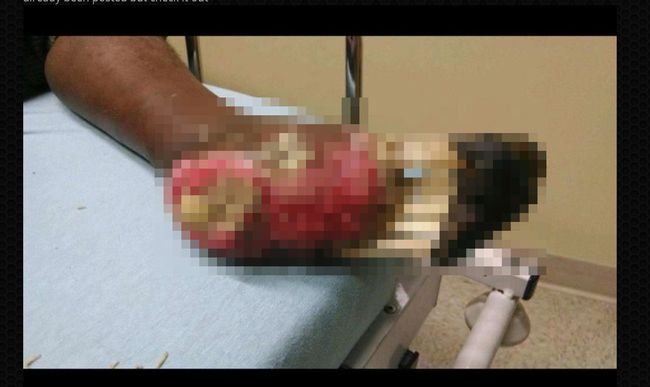 【閲覧注意】靴を6カ月間も脱がなかった男の足がトンデモないことに! 骨付き肉状態が悪夢すぎる!の画像1