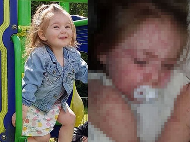 【閲覧注意】最悪の手足口病を発症した2歳幼女の悲劇! 全身を覆う赤いブツブツ、踊り狂うほどの痒み=英の画像1