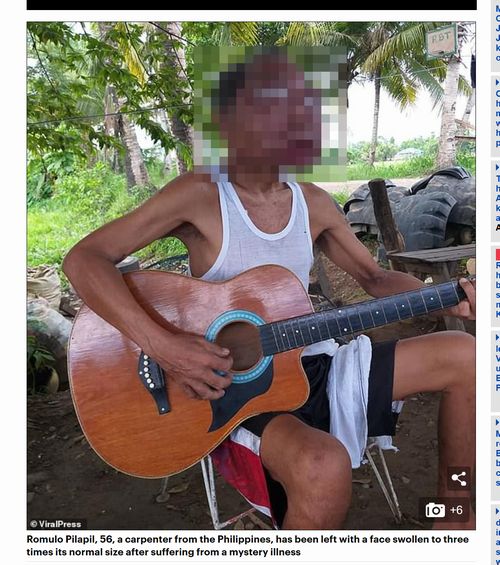 【閲覧注意】信じられない顔に変形してしまったお父さん！ 貧困のあまり治療不可、悲しみのギターを掻き鳴らす＝フィリピンの画像1