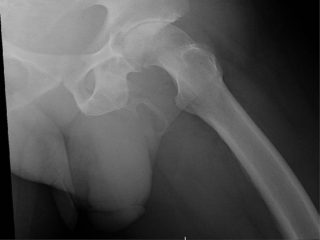 ペニスが骨になる奇病・陰茎骨化の患者が発見される！ 過去40例、激レアな股間を手に入れた男が医者の忠告を無視し…！