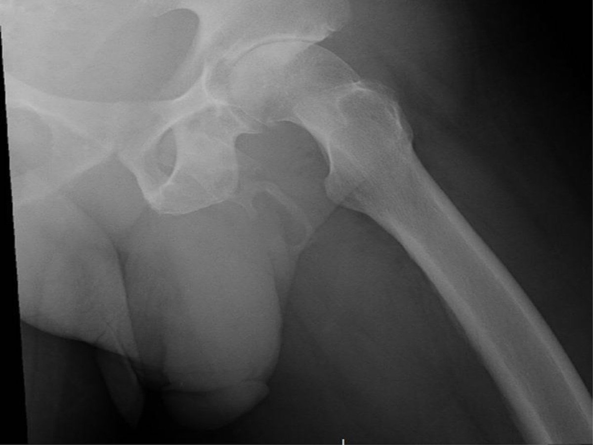 ペニスが骨になる奇病 陰茎骨化の患者が発見される 過去40例 激レアな股間を手に入れた男が医者の忠告を無視し