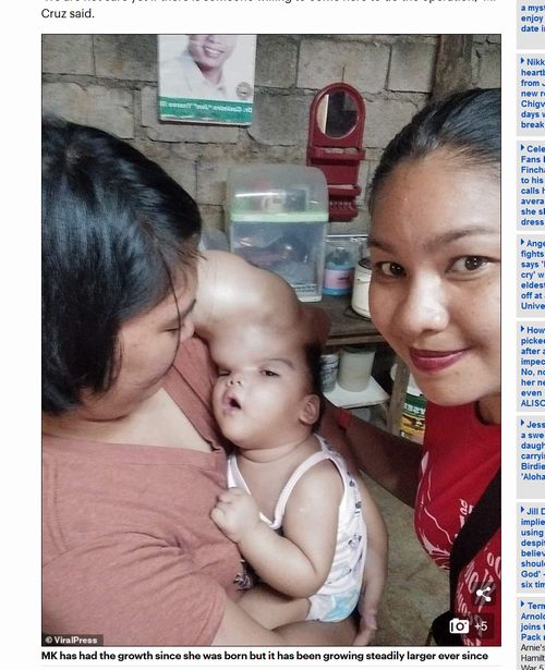 【閲覧注意】ハンマーヘッド赤ちゃんが誕生! 頭がどんどん膨張、手術できる医師がいない絶望的状況=フィリピンの画像4
