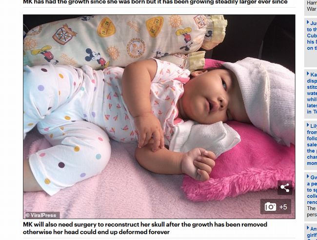 【閲覧注意】ハンマーヘッド赤ちゃんが誕生! 頭がどんどん膨張、手術できる医師がいない絶望的状況=フィリピンの画像5