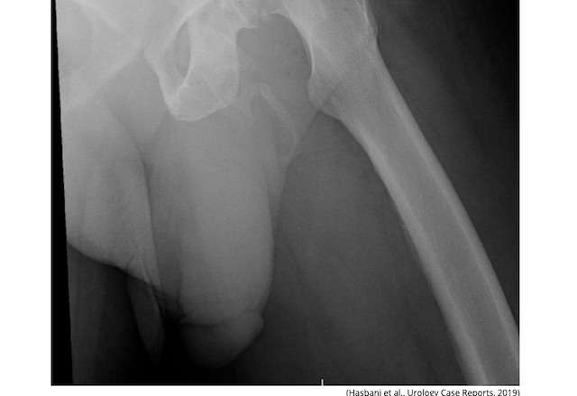 ペニスが骨になる奇病・陰茎骨化の患者が発見される! 過去40例、激レアな股間を手に入れた男が医者の忠告を無視し…!の画像2