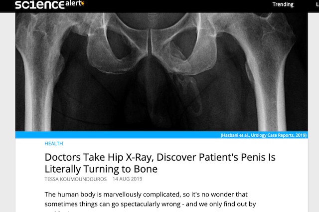 ペニスが骨になる奇病・陰茎骨化の患者が発見される！ 過去40例、激レアな股間を手に入れた男が医者の忠告を無視し…！の画像1