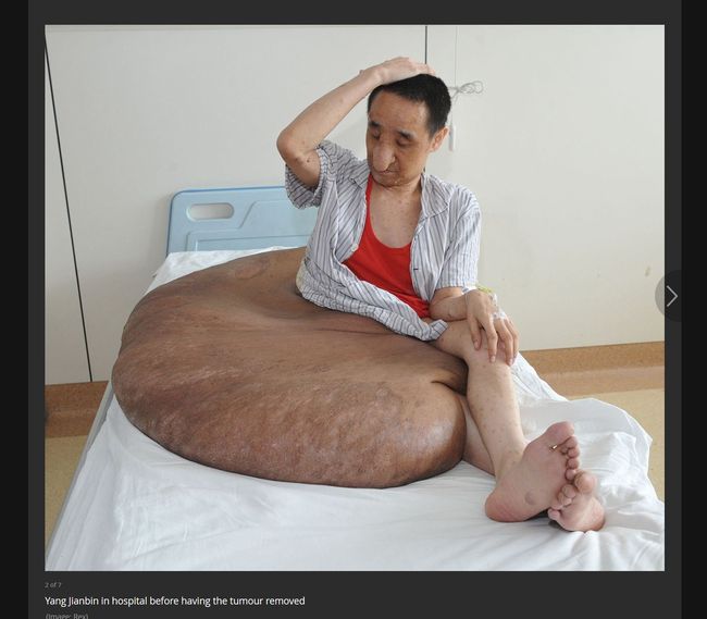 【閲覧注意】世界最大「110kgの腫瘍」が悲惨すぎて目を疑うレベル！ 全身が腫瘍クッションに埋もれて…＝中国の画像1