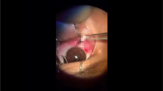 【閲覧注意】眼球にブッ刺さった鉛筆の先端を除去する激コワ手術映像流出! ピンセットでそうっと引き抜き…!の画像1