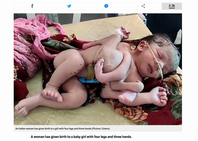 【閲覧注意】三つ子の二人が合体… 4本足と3本腕の赤ん坊が誕生! 原因は環境汚染か、薬害か!?の画像2