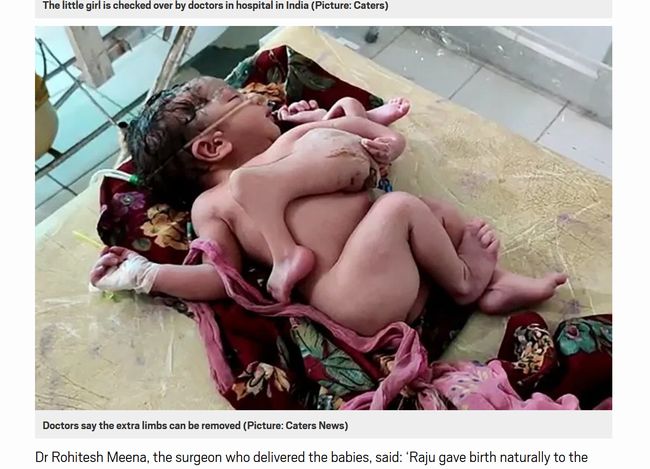 【閲覧注意】三つ子の二人が合体… 4本足と3本腕の赤ん坊が誕生! 原因は環境汚染か、薬害か!?の画像4