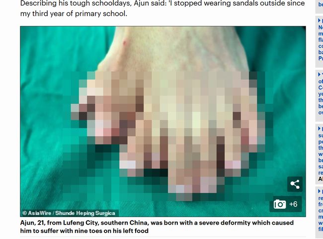 【閲覧注意】左足指が9本ある中国人男性がスゴい！ コンプレックスに耐えかねて切除手術を受けたら…！の画像1